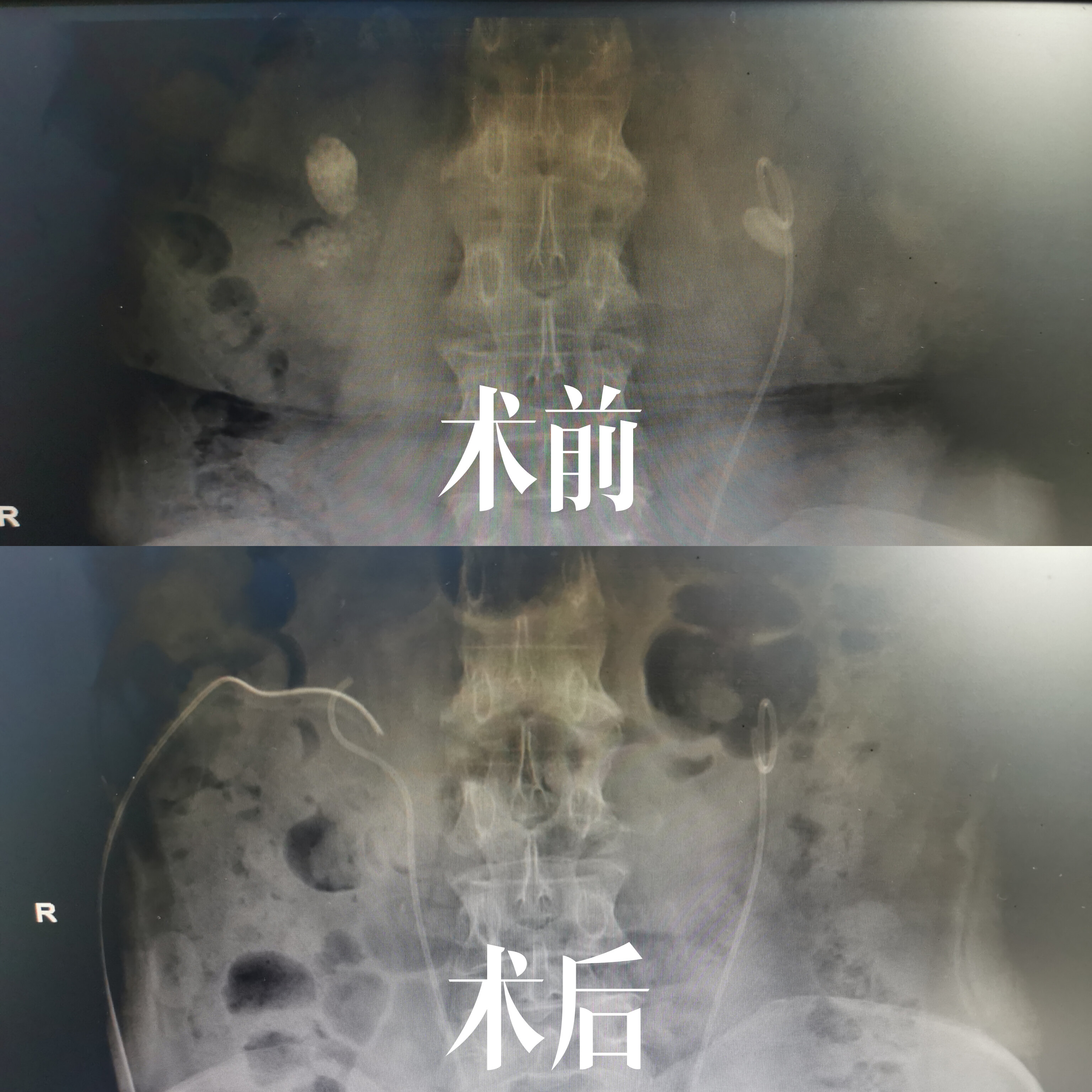 先天马蹄肾 双肾结石病人一例