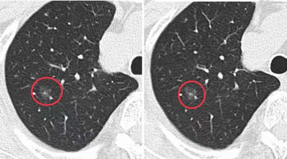 肺部磨玻璃结节的克星1024ct靶扫描