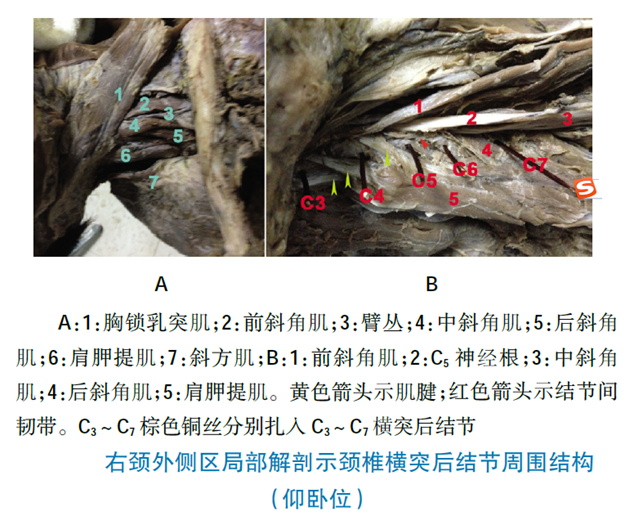 颈椎横突前结节形态及治疗意义