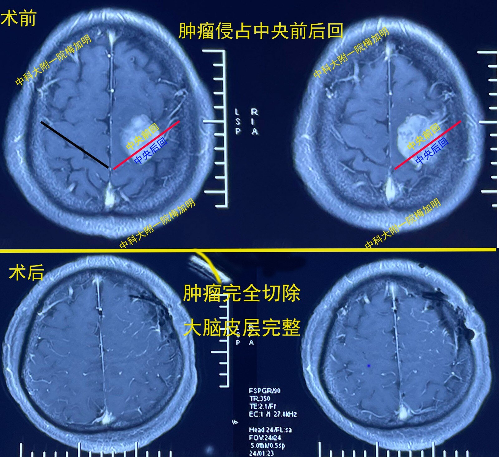 癫痫发作的真凶之一:中央区大型脑膜瘤(管理手脚活动区域的脑肿瘤)