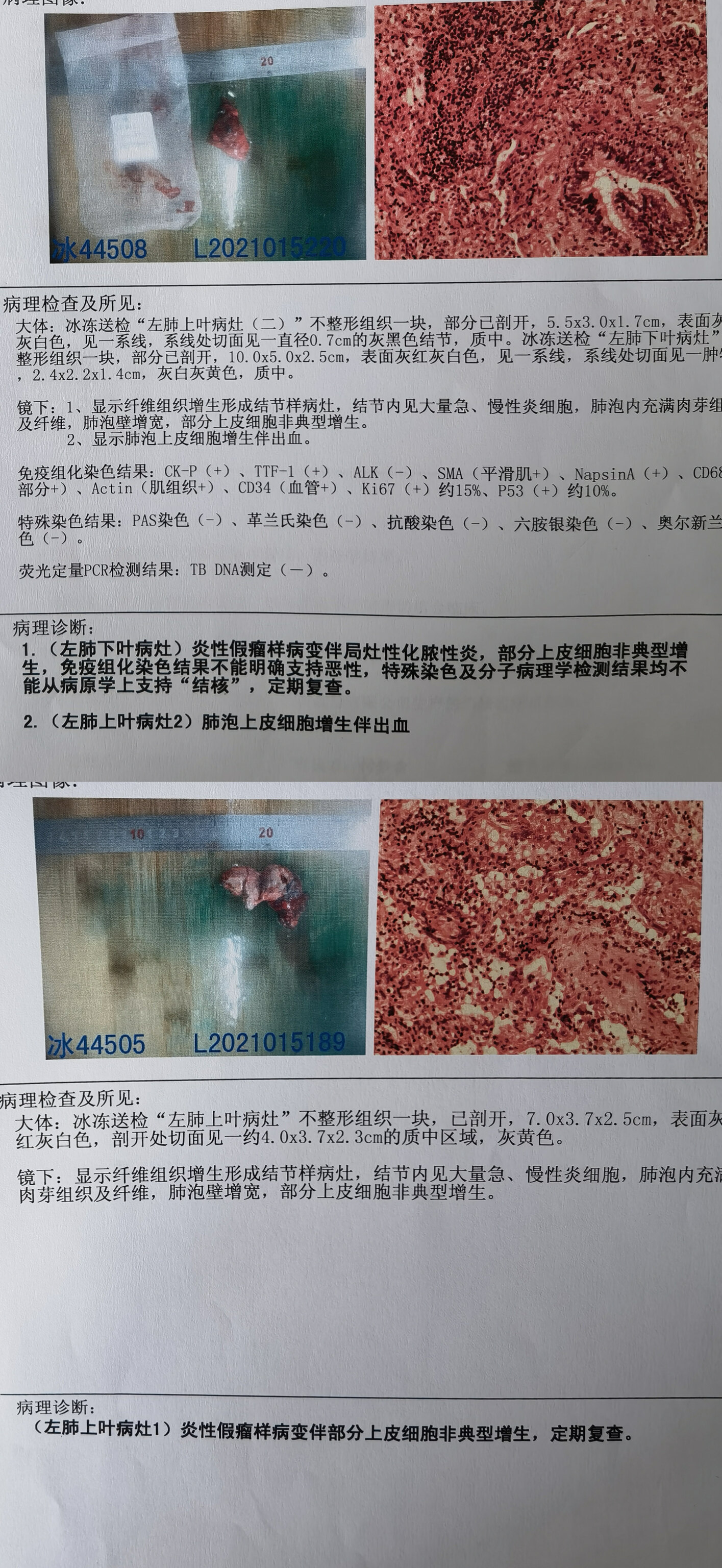 多发肺结节病变单孔胸腔镜uvats一次全部切除