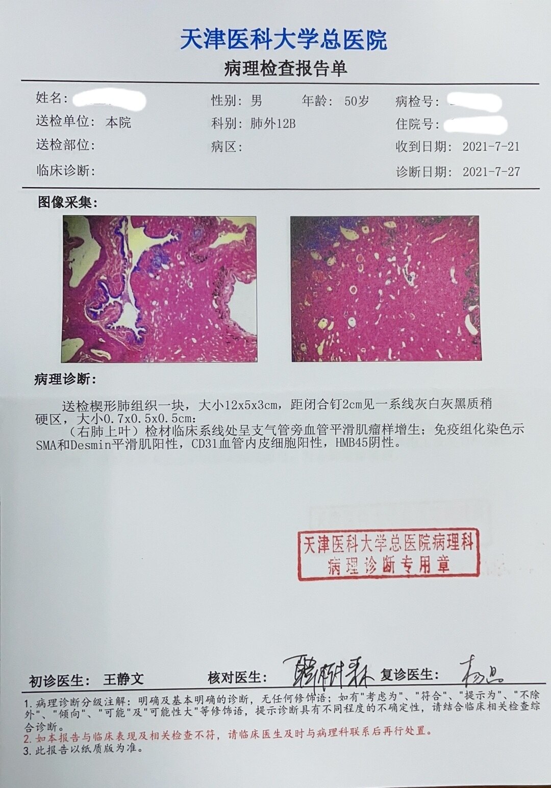 刘懿博士说肺癌二亖一六9毫米肺结节形态不规则一定是肺癌么