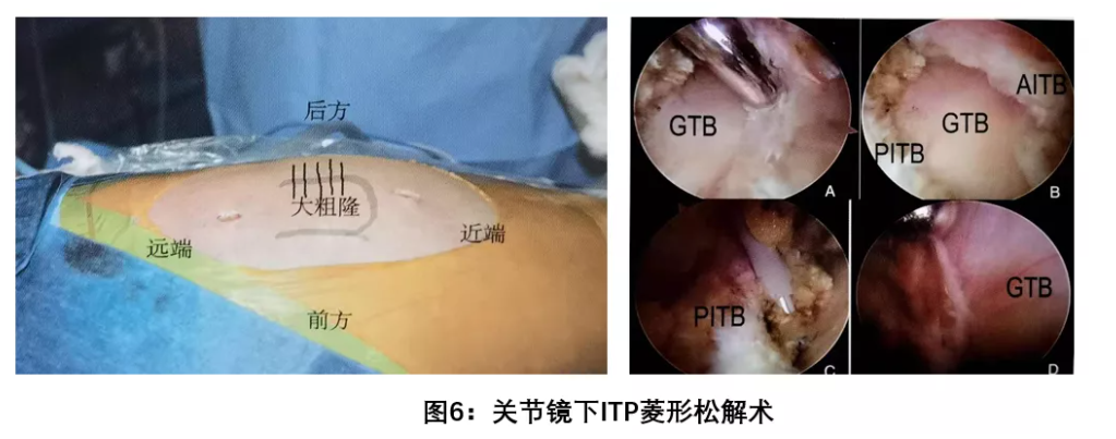 髋关节弹响怎么办需要手术治疗吗