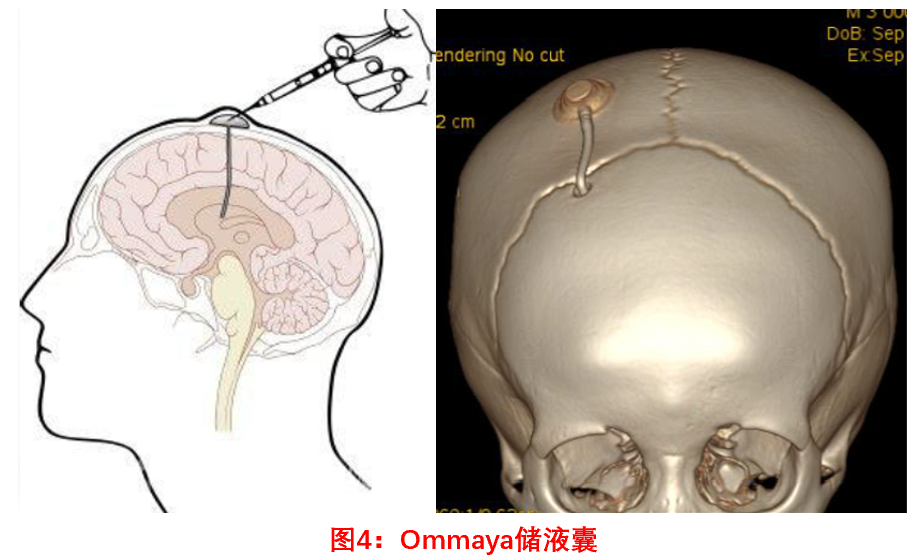 ommaya储液囊是一种脑室引流装置(图4),由一个埋在头皮下的扁平状的储