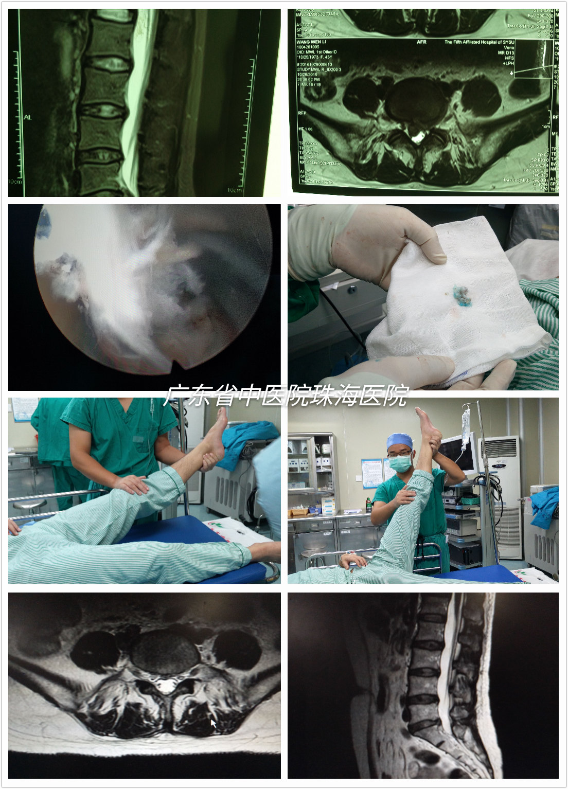 腰5骶1椎间盘突出微创后路椎间孔镜手术病例