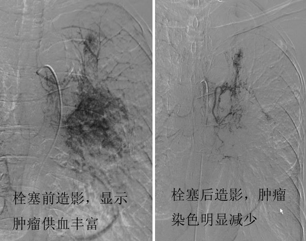 中央型肺癌的介入治疗