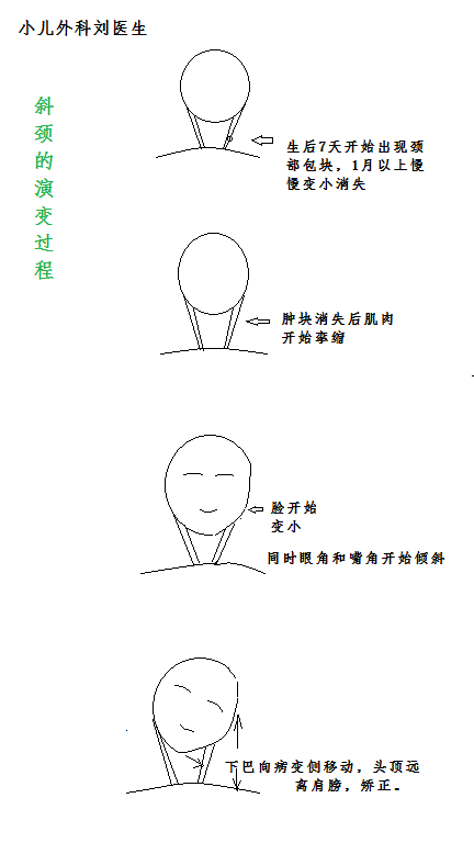 颈部肿块与肌性斜颈
