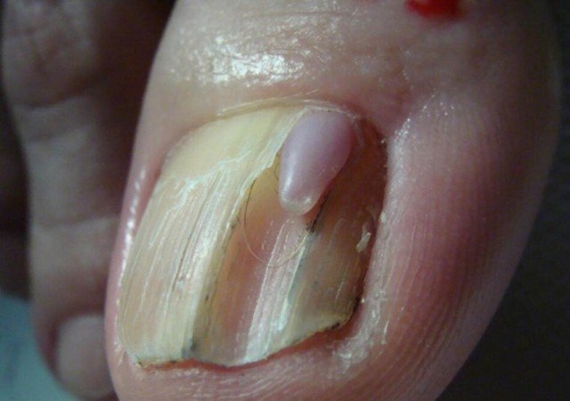 "甲母质瘤:不要误诊为"灰指甲"