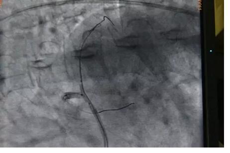 完全无造影剂下成功完成冠状动脉支架植入术