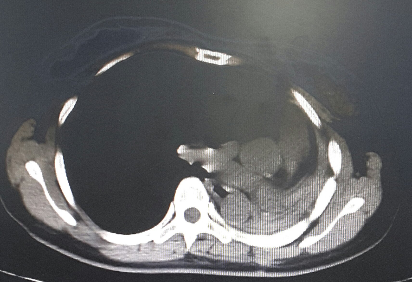 刘懿博士说肺癌(二七九)全肺切除术后无需胸穿