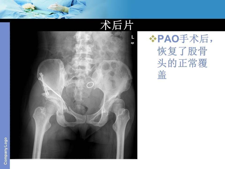 保髋手术基础入门篇