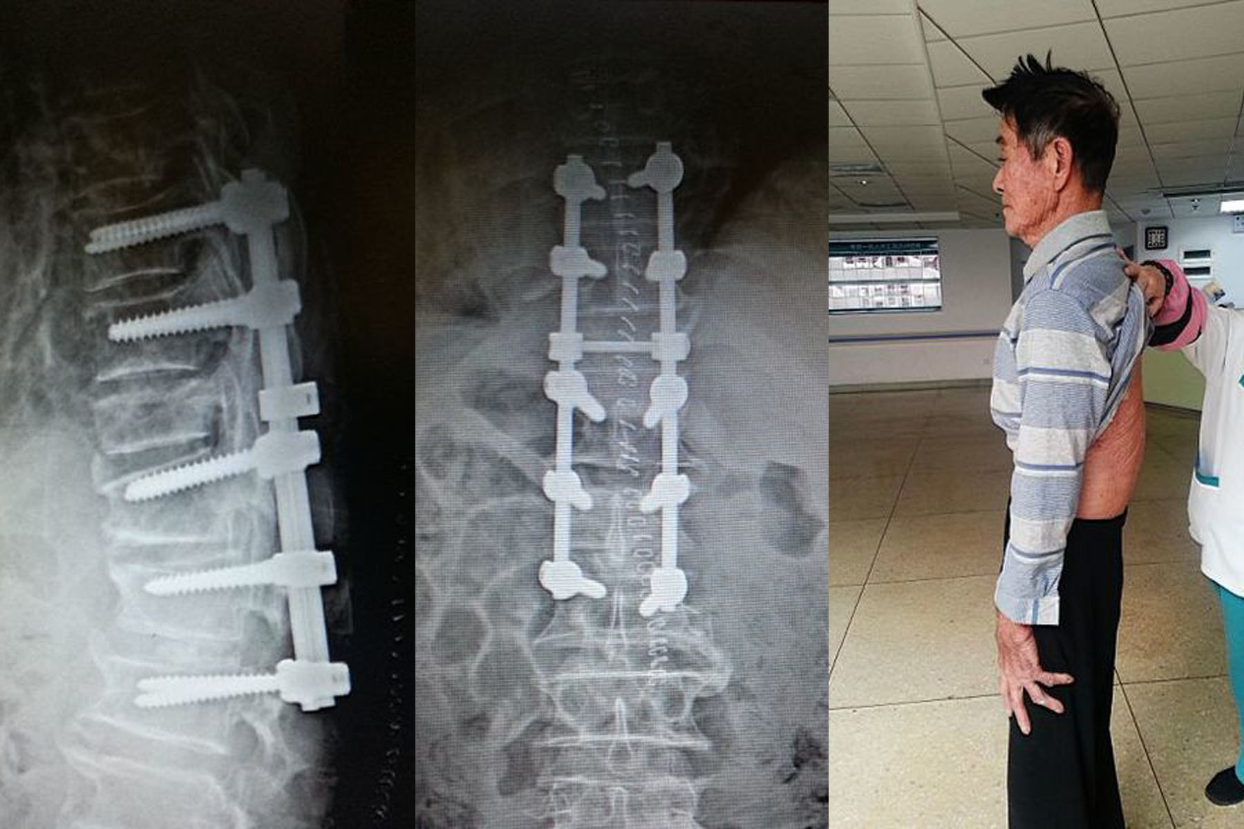 脊柱畸形矫正术(青少年脊柱侧弯,半椎体,后突驼背等)