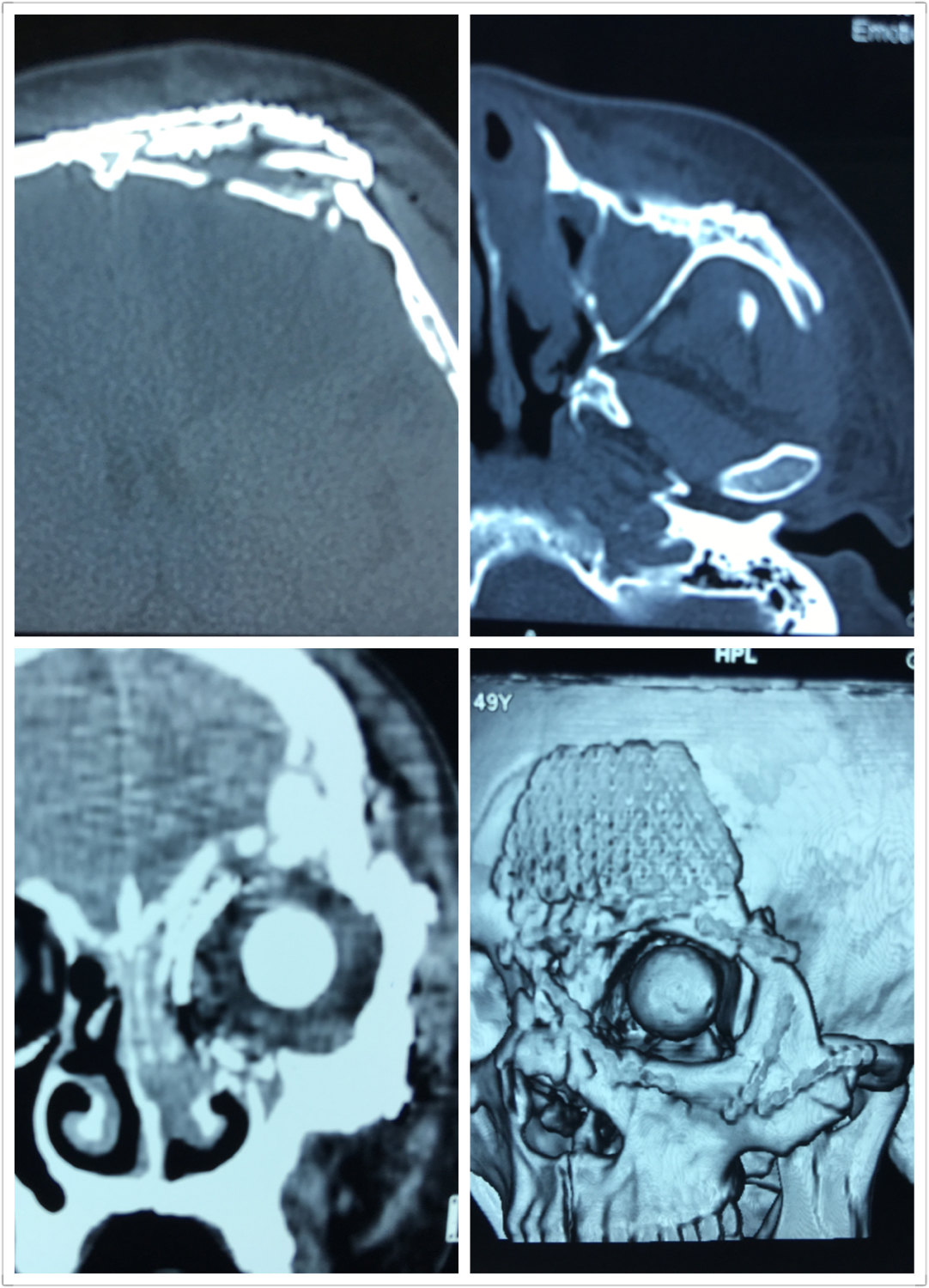 眼眶多发骨折伴眼球破裂