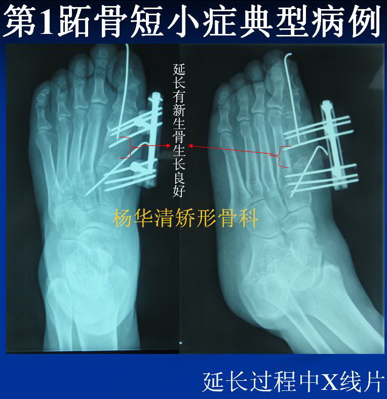 杨华清--第一跖骨短小症的治疗