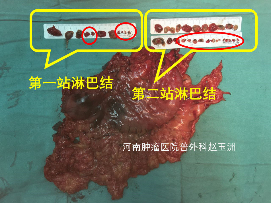 手术过程中必须将此两站淋巴结全部清扫掉,才可以最大限度的铲除可能