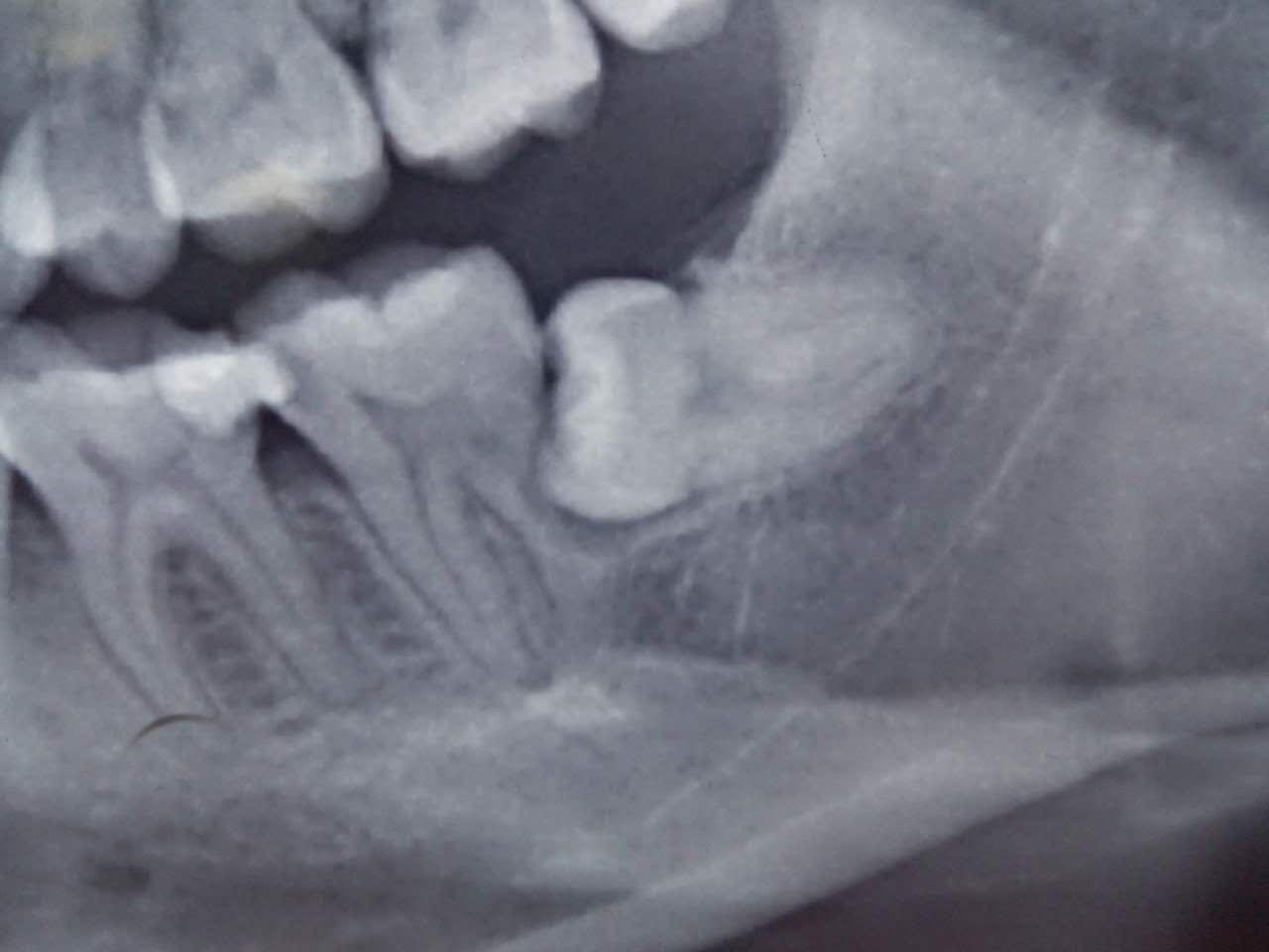 阻生牙拔与不拔