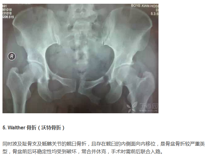 读懂骨盆 x 线片