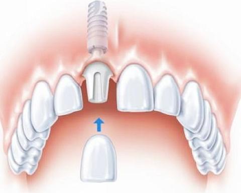 什么叫种植牙早期负重和渐进负重?_好大夫在