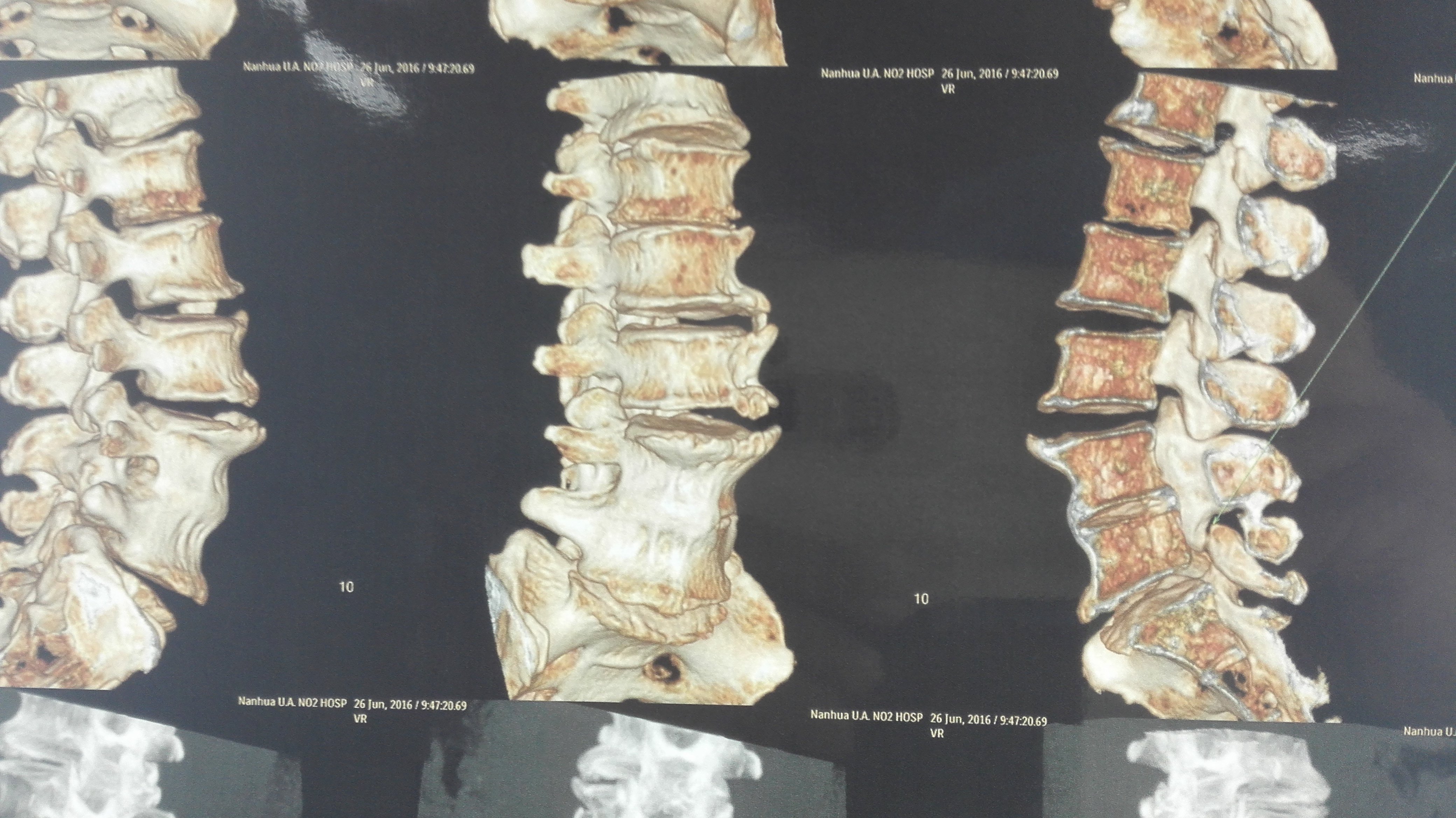 X光,CT,MRI(磁共振)检查有什么区别?_颈椎病_