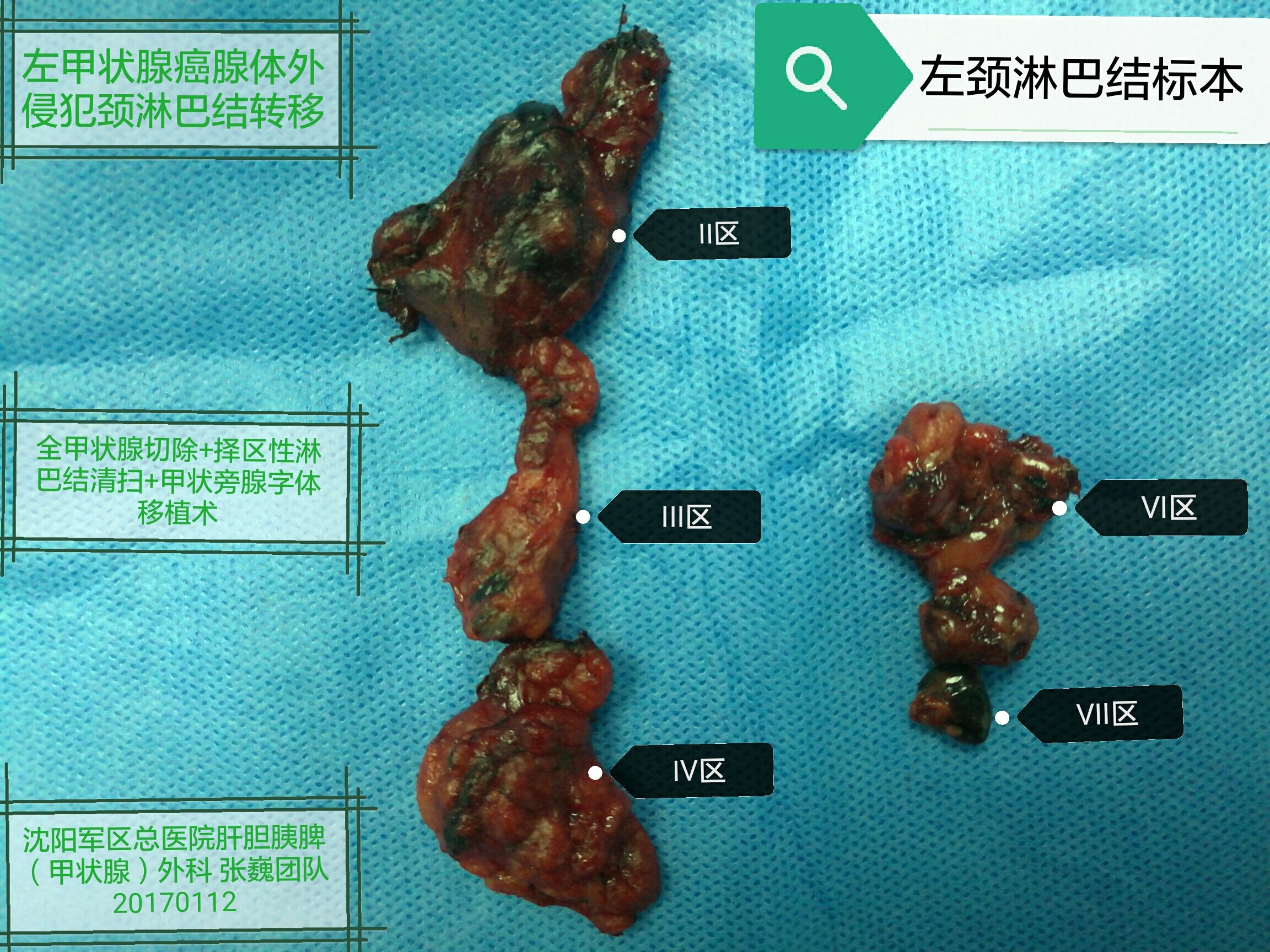 甲状腺癌病例分享