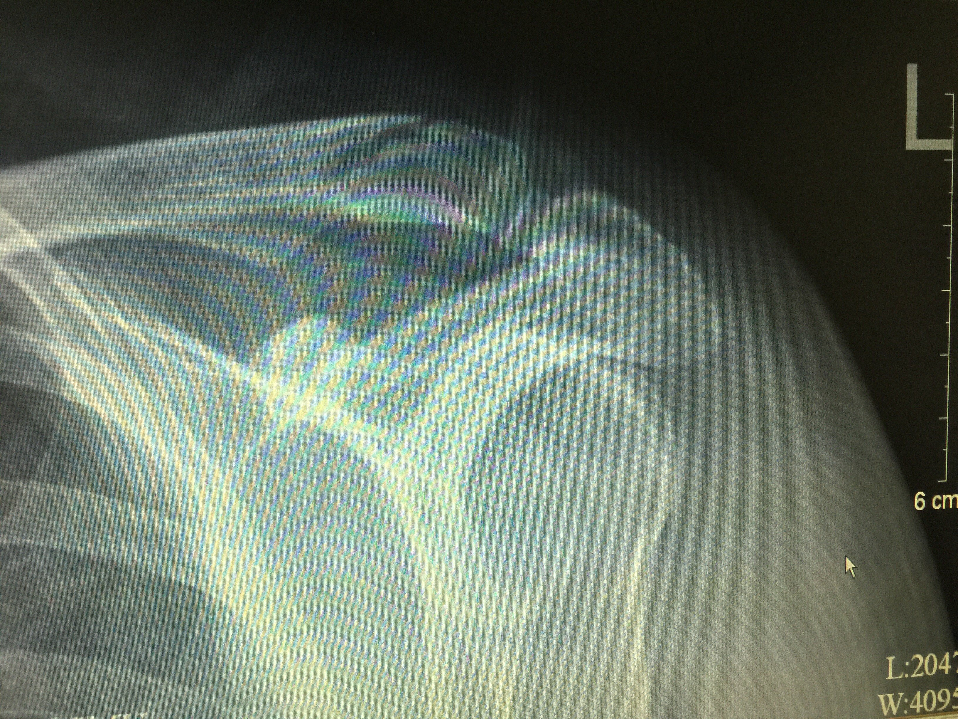 微创治疗锁骨远端骨折并喙锁韧带断裂