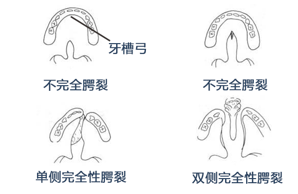 孩子得了唇腭裂,什么时候手术最好?