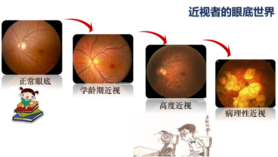 高度近视的危害眼底病变形成的原因是什么?