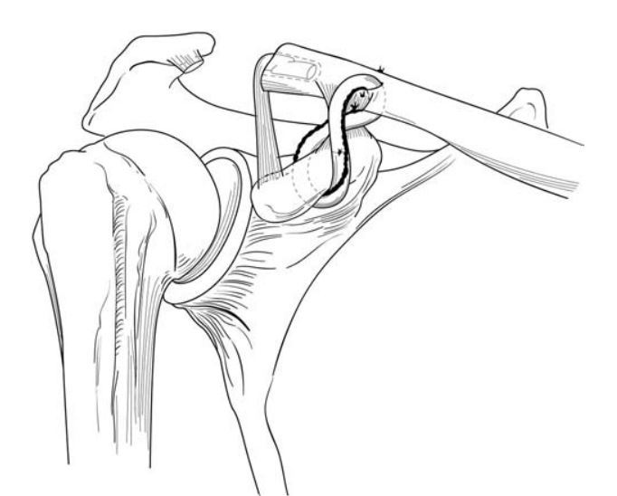 有多种重建喙锁韧带的方法.