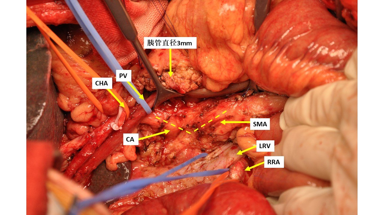 乳头癌,胰腺癌)移除标本后照片(后面观):后方要清扫至肠系膜上动脉