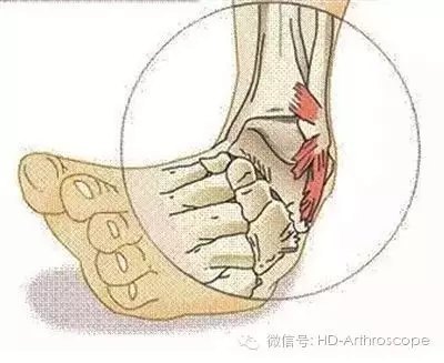 踝关节扭伤的处理和康复方法