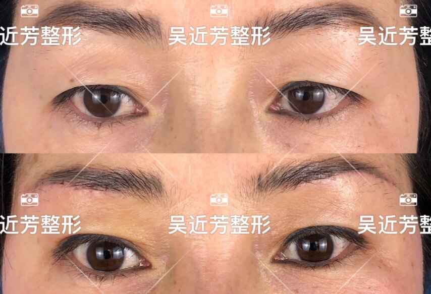 上睑 皮肤松弛,眼睛无神,内双,行提眉手术,术前与术后7天对比照片