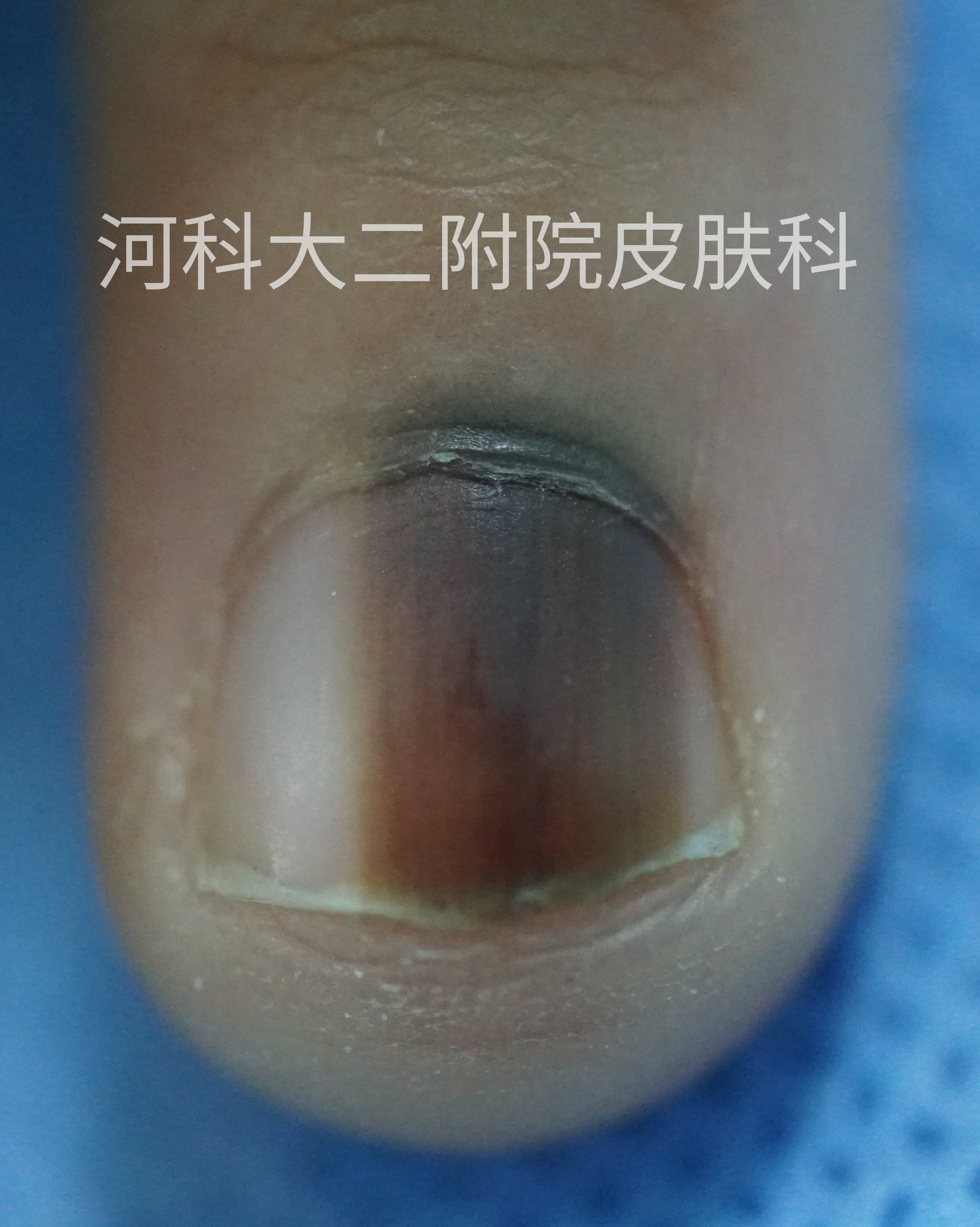 甲母痣