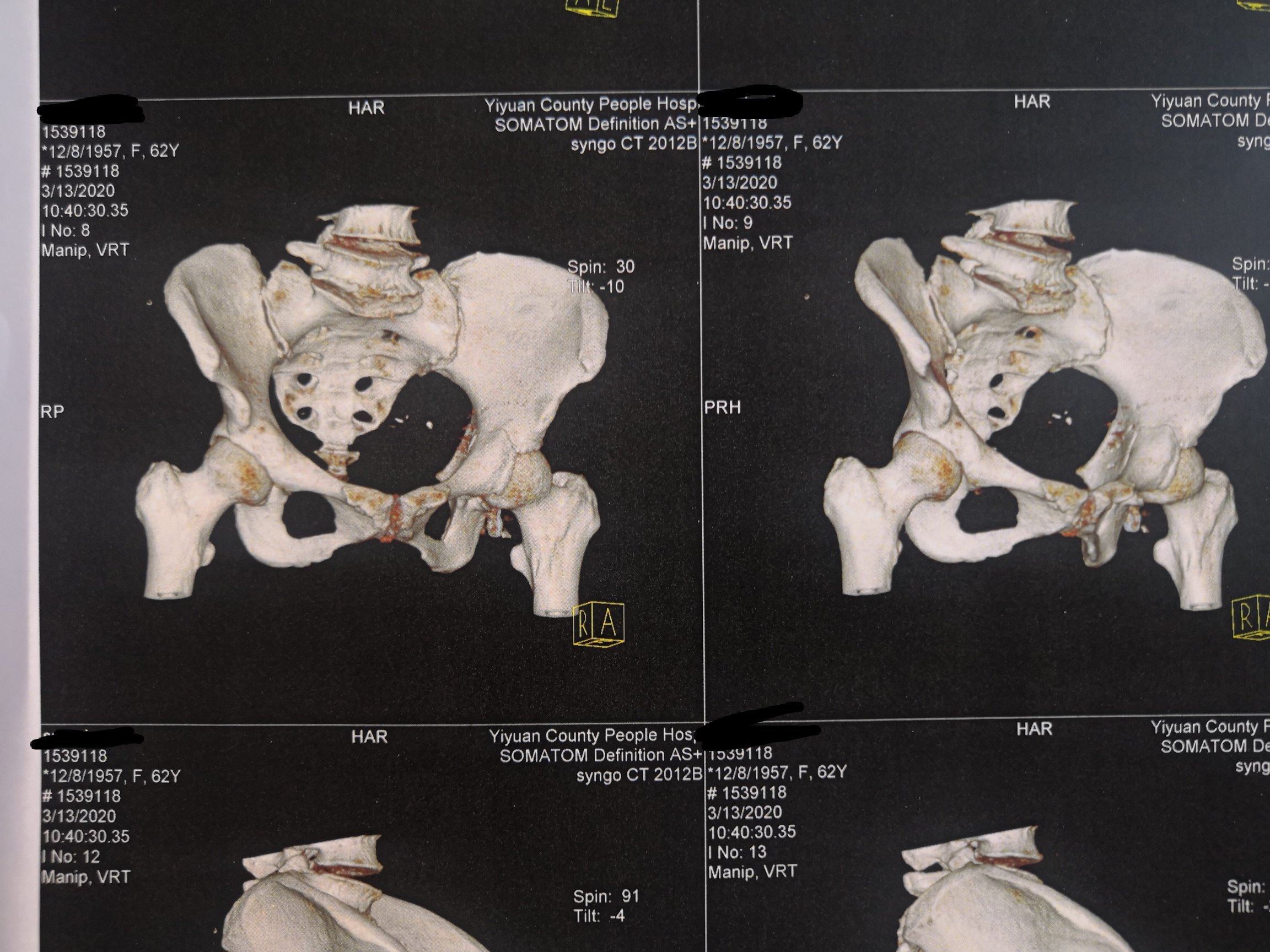 一例骨盆髋臼骨折合并另侧股骨髁上粉碎性骨折手术治疗