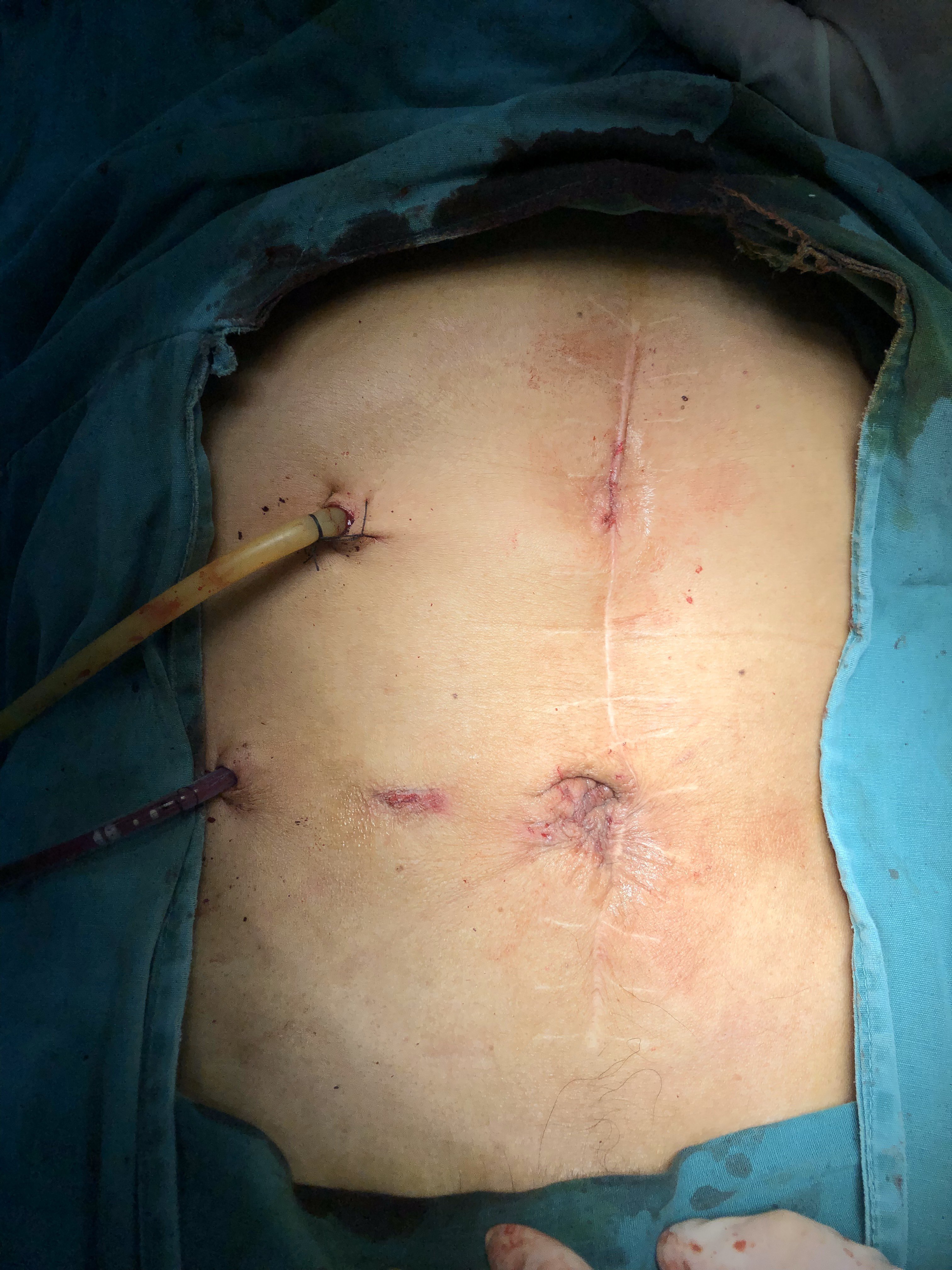 既往有胃癌手术史,胆总管结石微创手术结束后腹部微小切口展示