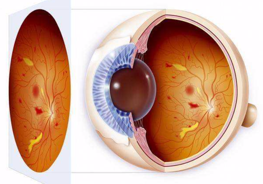 不可忽视的"视力杀手—糖尿病患者警惕眼底病变和白内障