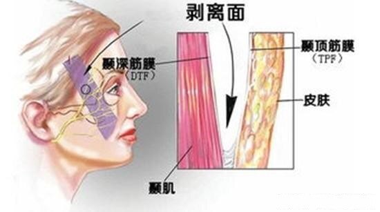 关于34面部五层提升手术34大家问的最多的是什么