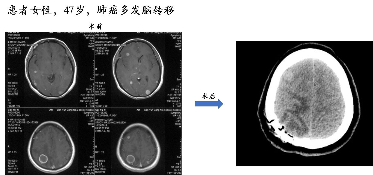 一定要引起重视:查头颅增强磁共振(mri) 脑转移瘤的治疗方法都有哪些
