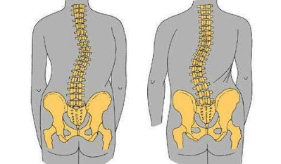 脊柱侧弯畸形影响健康吗这篇文章为你分析