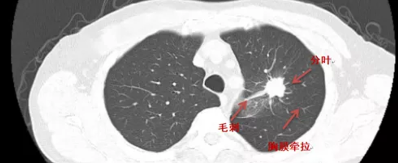 肿瘤的图像,ct上看到的恶性肺结节的一般为不规则生长,如分叶,毛刺