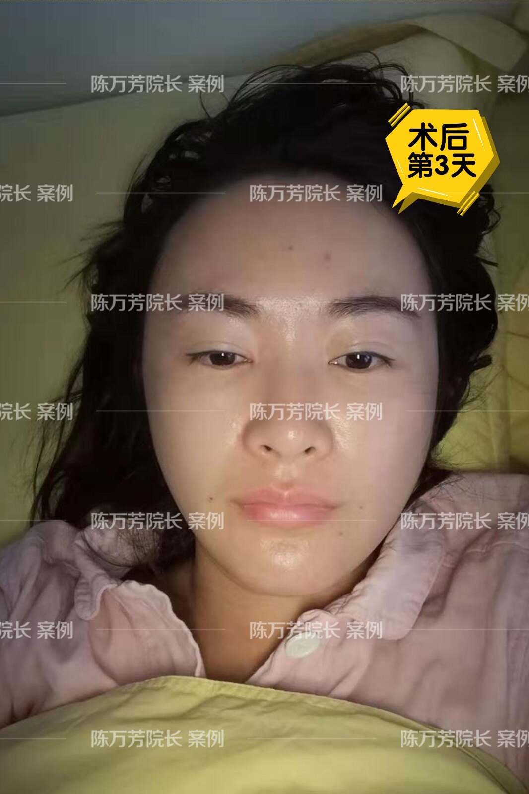 陈万芳讲脂肪全面部自体脂肪精雕案例