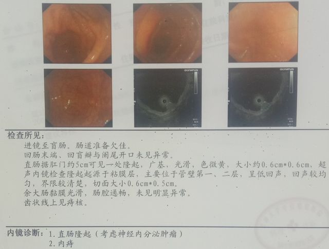 直肠神经内分泌肿瘤该如何治疗