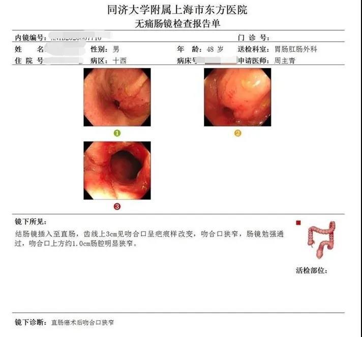 直肠癌保肛术后,吻合口重度狭窄,肛门保卫战!