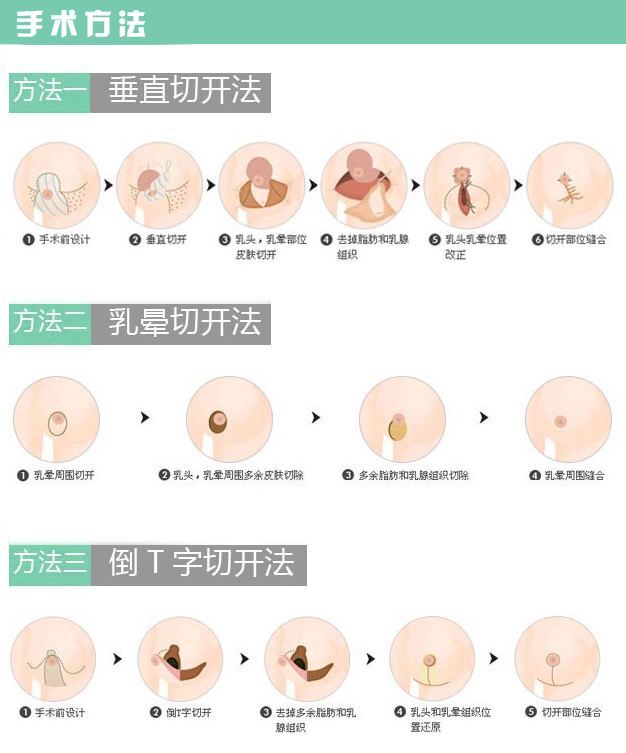 有数十种方法,主要有垂直切口内上蒂,倒t切口下蒂,环乳晕切口中央蒂等