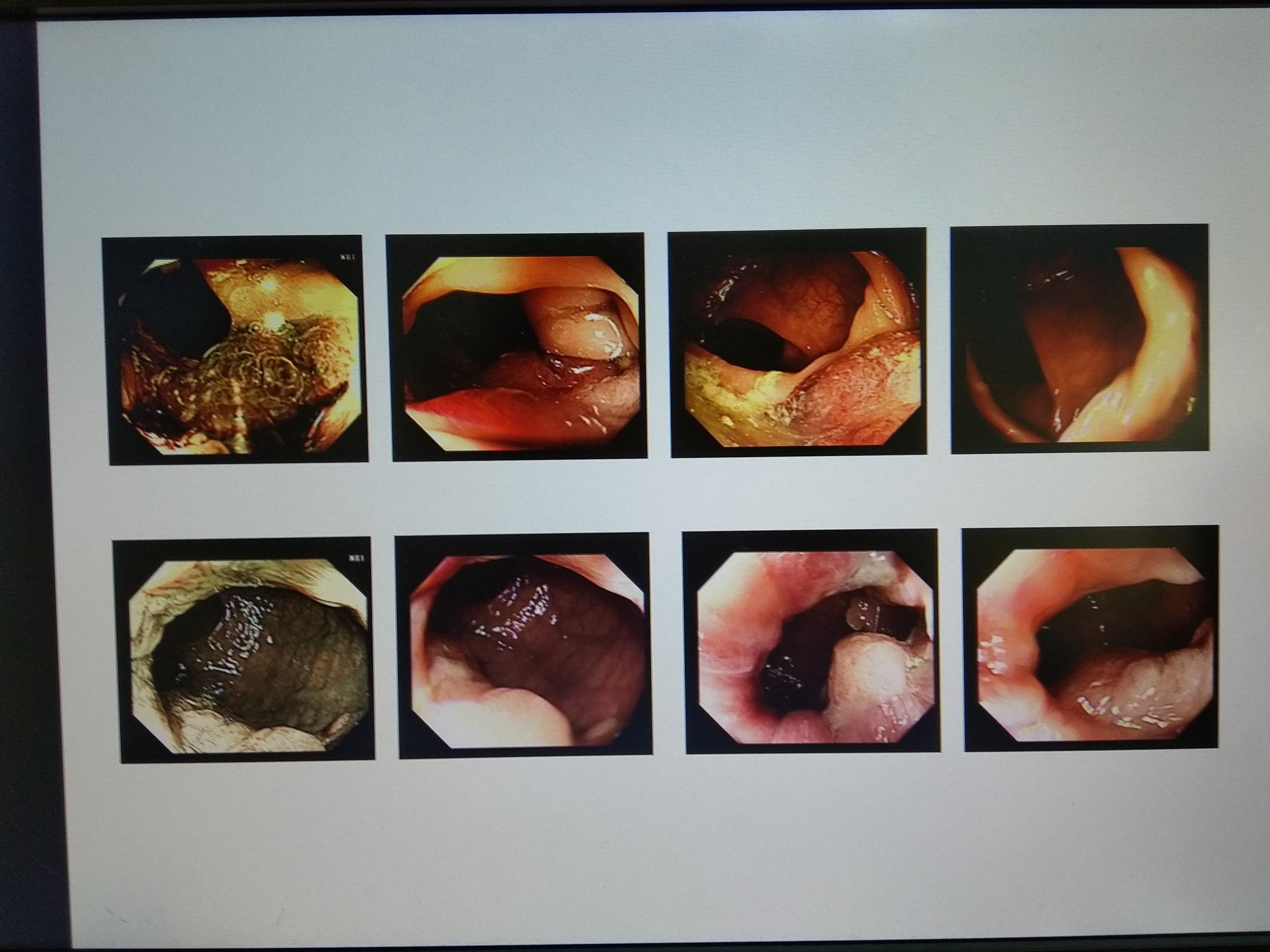 便血应重视肠镜检查尤其有明显混合痔存在时也不应忽视肠镜检查因为有