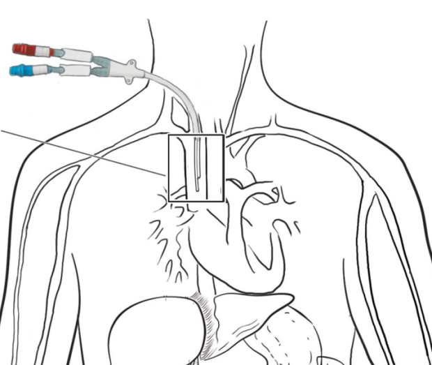 什么是血液透析中心静脉导管?