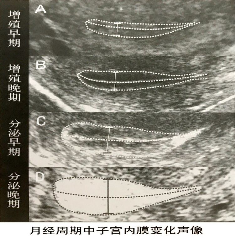 子宫内膜从月经后的菲薄状高回声;到增值早期的内膜功能层和基底层