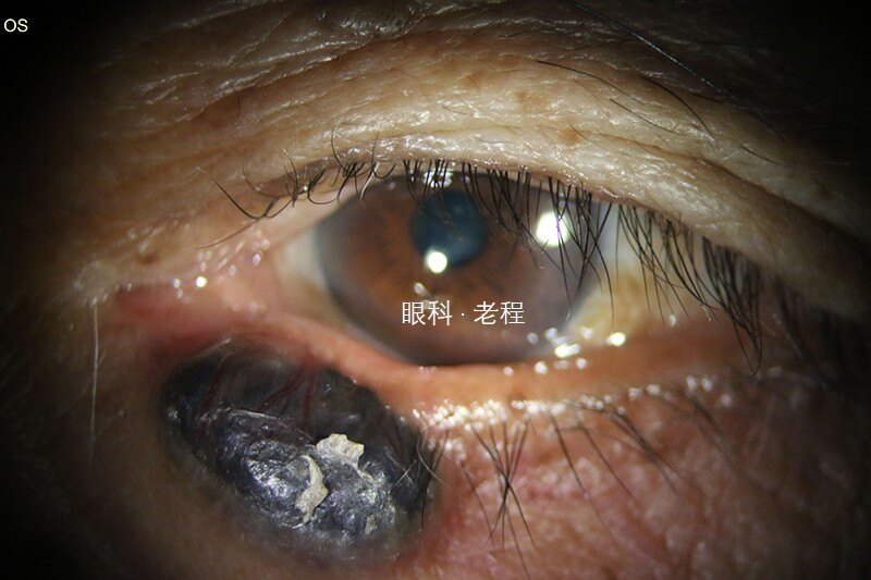 眼睑恶性肿瘤知多少?长啥样?