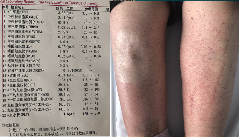 皮肤出血点