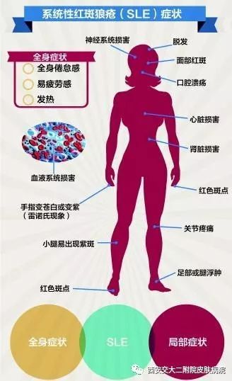 (二)系统性红斑狼疮