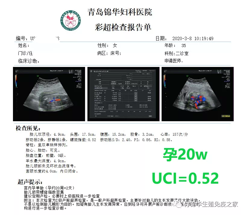 脐带螺旋指数知多少